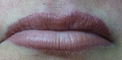 Lips after Contour & Blush (after 1 week the appearance will be 40% softer and lighter)