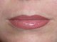 After Full Lip treatment (after 1 week the appearance will be 40% softer and lighter)