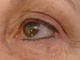  after SPMU eyes