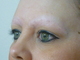After treatment