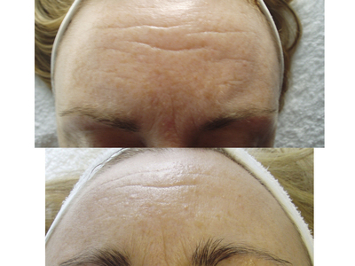 Forehead lines